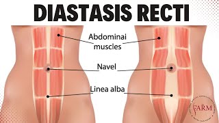 Diastasis Recti Breathing Exercises [upl. by Aylad]