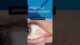 what is a pinguecula ¦eyecognizance [upl. by Tica]