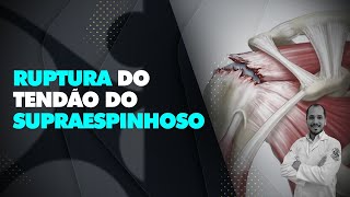 Ruptura do tendão do supraespinhoso [upl. by Irotal]