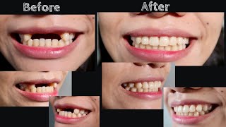 REMOVABLE PARTIAL DENTURE  Doc Noy [upl. by Aerua126]