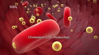 Arteriosclerosis [upl. by Mot]