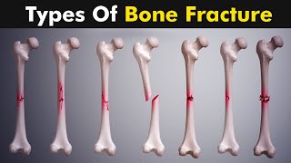 Common types of Bone fracture  3D animation [upl. by Venetia]