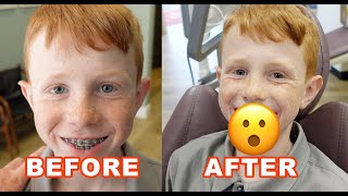 ENDER GETS HIS BRACES OFF BEFORE AND AFTER BRACES [upl. by Nevar]