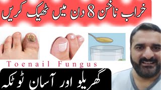 خراب ناخن کا علاج  Nail Fungus Healthmatters22 healthtips Healthmatters22 DrKhurram [upl. by Atnauq844]