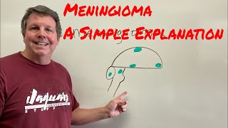 Meningioma A Simple Explanation [upl. by Icart]