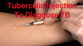 Tuberculin  How to Diagnose TB infection [upl. by Cott]