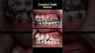 Teeth very crowded and crooked before braces orthodontist braces dentist [upl. by Aicilas]