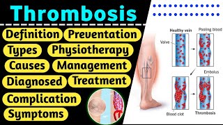 Thrombosis  Thrombosis in hindi  DVT  Thrombosis definition  thrombosis pathology [upl. by Pacheco]