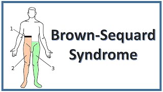 BrownSequard Syndrome  NEET PG  FMGE  USMLE [upl. by Eet]