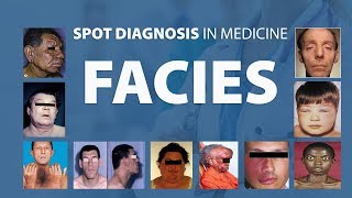 Abnormal Facies  Spot Diagnoses in Medicine [upl. by Viviene670]