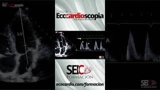 Curso de Ecocardioscopia Ecocardiografía básica [upl. by Saw]