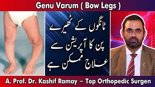 3 Genu Varum  Bow Legs   Dr Kashif Ramay  2018 [upl. by Rehpatsirhc651]