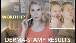 DERMA STAMP MICRONEEDLING RESULTS  skip2mylou [upl. by Aynnat99]