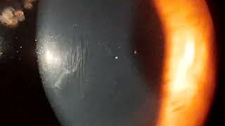 Vogts Striae in Keratoconus [upl. by Macrae]