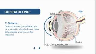 Síntomas y tratamiento del queratocono  Clínica Baviera [upl. by Nessim704]