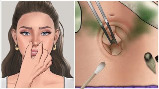 ASMR 냄새나는 배꼽 결석 제거 애니메이션  Remove Huge Navel Stone Animation [upl. by Hans]