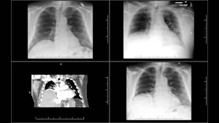 Chest tube probably injured phrenic nerve and cause right diaphramatic paralysi [upl. by Pathe]