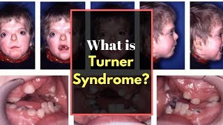 Turner syndrome Symptoms  Causes Pictures Signs and Symptoms of Turners syndrome [upl. by Htnnek]