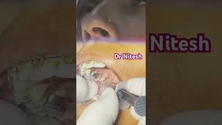 Inferior alveolar nerve block [upl. by Northway]