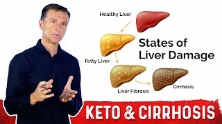 Why a Fatty Keto Ketogenic Diet Can Help Reverse a Fatty Liver – Dr Berg [upl. by Ettelohcin]