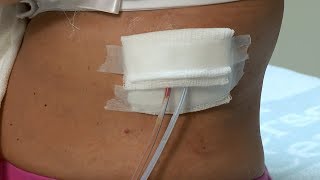 How to care for a postsurgery wound drainage system and gauze dressing [upl. by Issac]