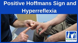 Positive Hoffmans Sign and Hyperreflexia [upl. by Sil]