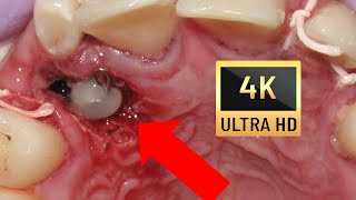 🤔HOW BRACES WORK Amazing Impacted Canines  Explained💖 in 4K 7Year Followup❗💚 [upl. by Tamqrah]