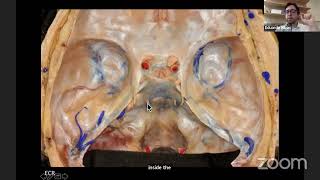 Anatomy of the cavernous sinusDr Eduardo S Carvalhal Ribas [upl. by Ttemme]