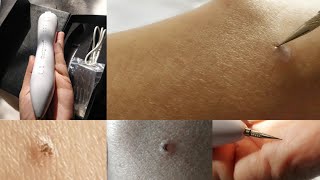 मैंने finally try किया Freckle और mole removal pen। देखिए इसे कैसे use करना है। [upl. by Aerdnaek793]