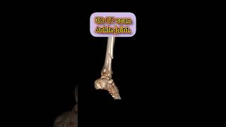 3DCT scan of Ankle Joint anklebreakers jointpain fracture ctscan legs ctankle foot [upl. by Buckie]