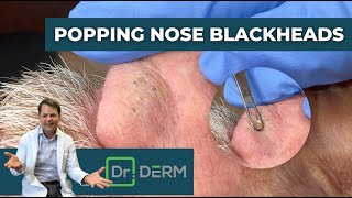 Popping Nose Blackheads  Dr Derm [upl. by Gautea220]