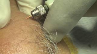 Permanent painless hair removal of chin electrolysis [upl. by Alo]