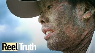 My Skin is Killing Me  Epidermolysis Bullosa  Extraordinary People Documentary  Reel Truth [upl. by Greeson]