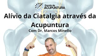 Alívio da Ciatalgia através da Acupuntura [upl. by Okomot]