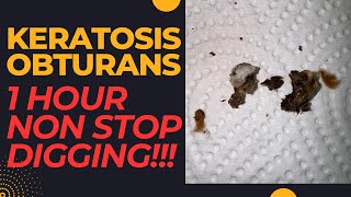 KERATOSIS OBTURANS  1 Year Of Hearing Loss Resolved 😮‍💨😮‍💨😮‍💨 [upl. by Iohk]