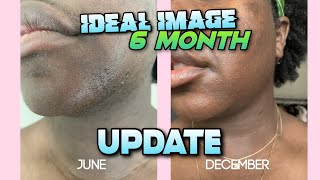 Vlogmas Day 20  Laser Hair Removal 6 Month Update  Does Numbing Cream Work For Laser Treatments [upl. by Kcub]