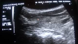 ultrasound  PARATHYROID GLAND [upl. by Sirahs102]