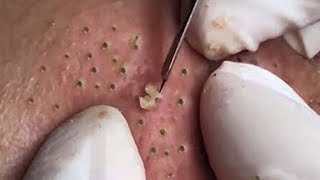 How To Remove Blackheads And Whiteheads On Face Easy 82 ✦ Dr Laelia ✦ [upl. by Elbam]