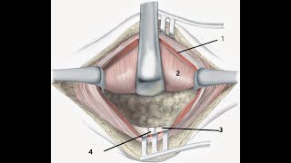 Transverse Pfannenstiel incision [upl. by Nuahs316]