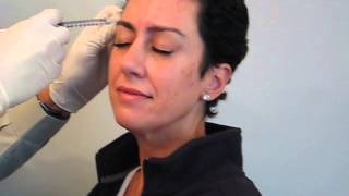 Botox injections by Dr A Mauskop at the New York Headache Center [upl. by Rozalin720]