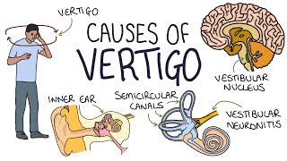 Understanding the Causes of Vertigo [upl. by Aticnemrac]