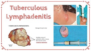 TUBERCULOUS LYMPHADENITIS  Stages Of TB Lymphadenitis  Cold Abscess  General Surgery [upl. by Karp]