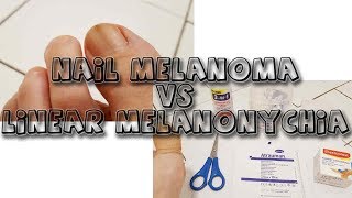 Nail Melanoma VS Melanonychia  learn from my story [upl. by Helge]