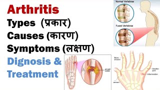 Arthritis  Types Causes Symptoms Diagnosis Treatment  Science Explored  In Hindi [upl. by Odysseus834]