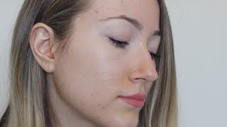 THE TRUTH WHY ACCUTANE DIDNT WORK [upl. by Dej606]