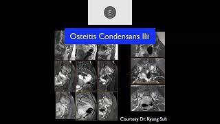 MRI of the Hip Part 3 – Hip Trauma [upl. by Oiled]