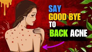 Home Remedies For Back Acne  How to Get Rid of Acne  Pimples on Back [upl. by Redlac]