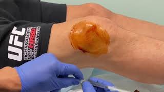 MoraMD Knee Effusion Aspiration A Nearly Painless Technique [upl. by Lamori652]