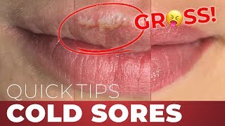 Negative Side Effects of Permanent Lip Makeup Cold Sores Quick Tips [upl. by Greenquist]