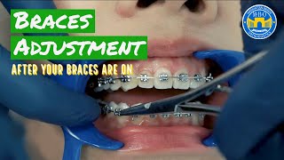 How Do Braces Straighten Teeth [upl. by Eiramadnil]